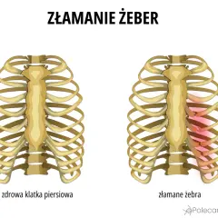 Porównanie zdrowej klatki piersiowej z klatką z widocznym złamanym żebrem, zaznaczonym na czerwono.