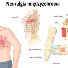 Ilustracja pokazuje ból w klatce piersiowej, objawy neuralgii międzyżebrowej i anatomię nerwów.
